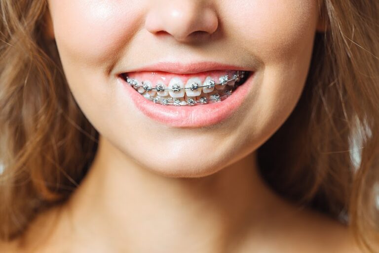 What’s The Difference Between Braces and Veneers? 2022 Guide Emlii